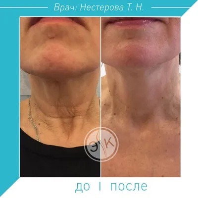 Инъекции Radiesse (Радиесс) векторный лифтинг в Москве. Цена 25 110 руб.