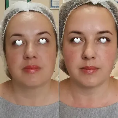 Векторный лифтинг Радиесс | Цена процедуры в Age Clinic (Москва)