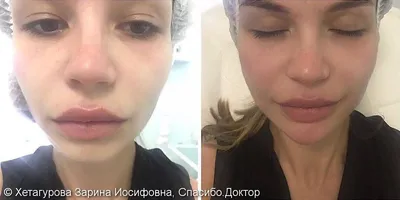 Векторный лифтинг препаратом Radiesse