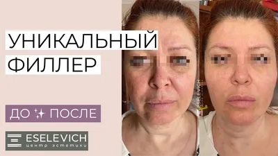СМАС лифтинг Liftera A + Radiesse - новый секрет омоложения!