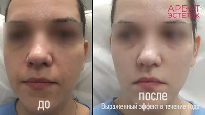 Векторный лифтинг Радиесс 3мл до и после через 2недели,через 2месяца будет  еще лучше… | Instagram