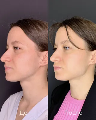 Антиэйдж процедуры в 30+: что делать? | Beauty Insider
