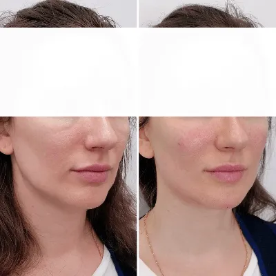Векторный лифтинг Радиесс | Цена процедуры в Age Clinic (Москва)