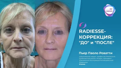 Контурная пластика Radiesse в Москве: цены, фото до и после, отзывы |  Стоимость контурной пластики Radiesse в клинике Seline