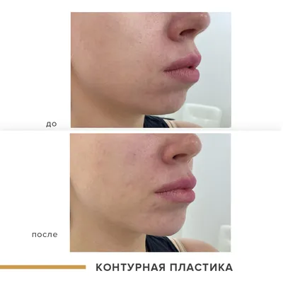 Радиесс (Radiesse) в Киеве | Клиника Юлии Ивасенко