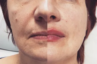Radiesse (Радиес) — Сеть салонов красоты Naturel Studio