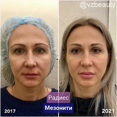 Radiesse Радиесс векторный лифтинг | Подтяжка лица