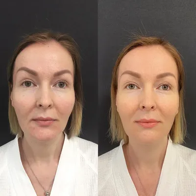 Meso-Radiesse® - Клиника Красоты vipMedicum