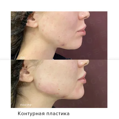 Волюмизация RADIESSE (Радиесс) в СпБ. Цена. Фото, отзывы — AesteticaMed