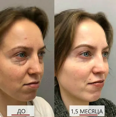 Подтяжка лица SMAS лифтинг: фото во время и после операции | Beauty Insider