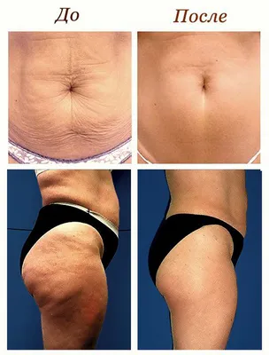 Фото до и после | Клиника аппаратной и инъекционной косметологии Vitaura