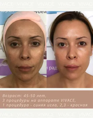 RF-лифтинг в Москве - Клиника Beauty Practice