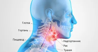 Рак горла - симптомы, диагностика, лечение опухоли в горле