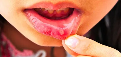 Рак губы: симптомы, первые признаки, диагностика и лечение опухоли губы