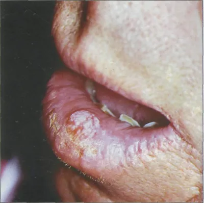 Рак нижней губы - Стоматология