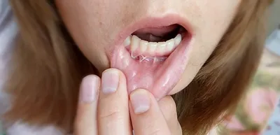 Шишка на внутренней стороне нижней губы: причины, симптомы и лечение