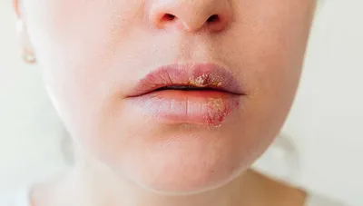 Причины пузырьков на губах: герпес, рак и другие заболевания - срочная  запись к врачу