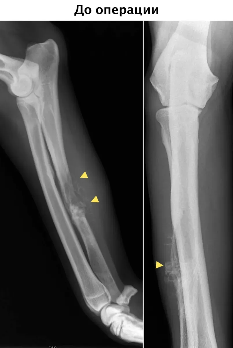 Саркома кости ноги. Саркома Юинга большеберцовой кости рентген. Остеосаркома левой большеберцовой кости. Остеосаркома коленного сустава рентген. Остеосаркома большеберцовой кости рентген.