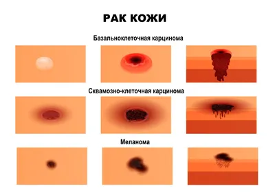 Плоскоклеточный рак кожи - причины появления, симптомы заболевания,  диагностика и способы лечения