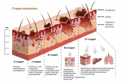 Рак кожи: симптомы, как выглядит, признаки, стадии, лечение