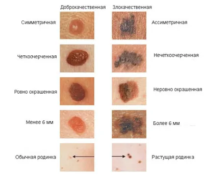 Рак кожи - симптомы и признаки | Центр лечения онкологии СМ-Клиники