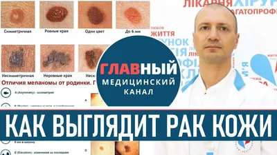 Рак кожи: симптомы, диагностика, лечение, прогноз