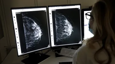Рак молочной железы реальные фотографии