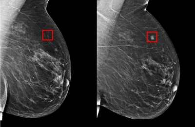 Рак молочной железы: симптомы, лечение признаки рака груди у женщин и мужчин