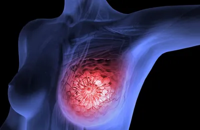 Местно-распространенный рак молочной железы: симптомы, диагностика и лечение
