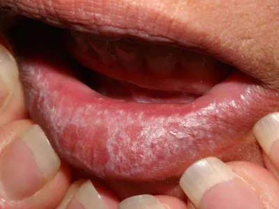 Красный плоский лишай в полости рта: терапия лекарственными препаратами и  народными средствами