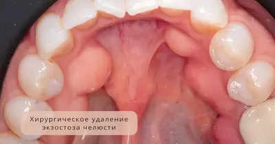 Болит Небо Сверху Почему Воспалилось ЛюмиДент