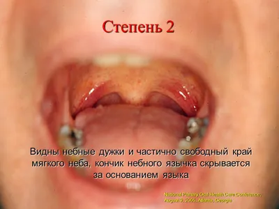 плоскоклеточный рак (Интересный случай) / Поиск по тегам (карцинома,  мутации, онкогены, базальноклеточный рак, hedgehog) / Medicine Live