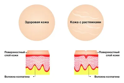 Можно ли убрать растяжки на тела - способы | Red Clinic в Новосибирске