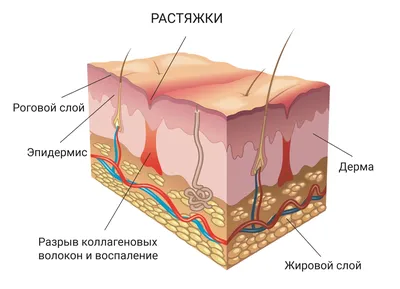 Растяжки на коже (рекомендации врача)