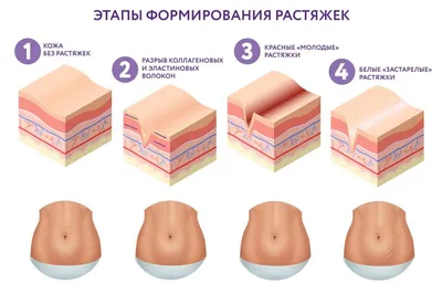 От чего появляются растяжки на теле - как избежать и предотвратить  появление растяжек