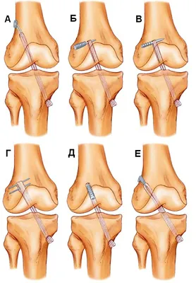 Восстановление после разрыва связок коленного сустава — (клиники Di Центр)