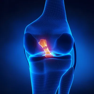 Разрыв передней крестообразной связки коленного сустава: симптомы, причины  и лечение
