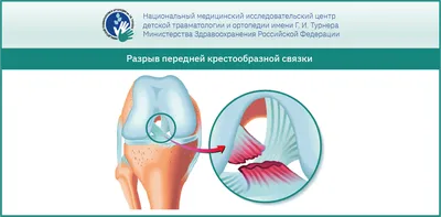 Разрыв передней крестообразной связки коленного сустава операция |  Артроскопия связок | Москва