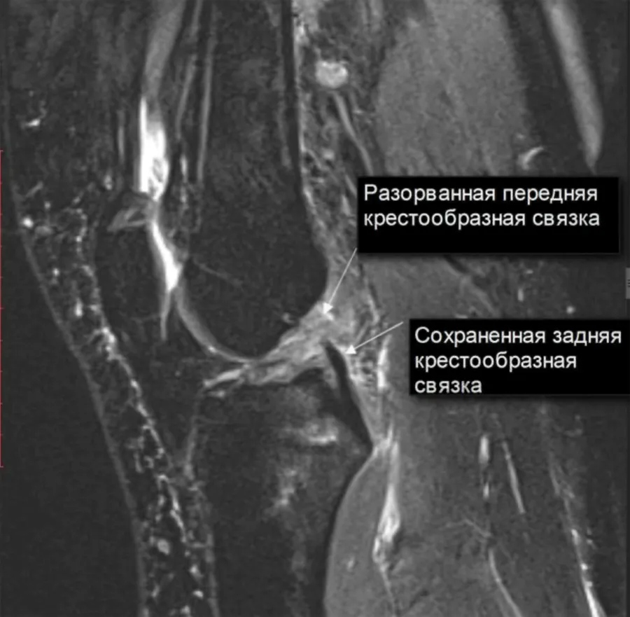 Мукоидная дегенерация крестообразной связки