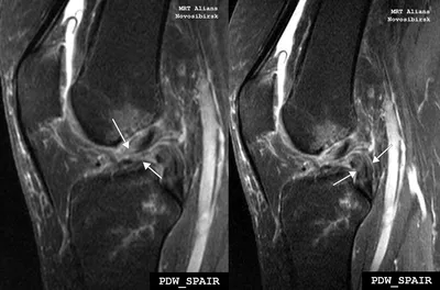 Разрывы передней крестообразной связки - Клиника 29