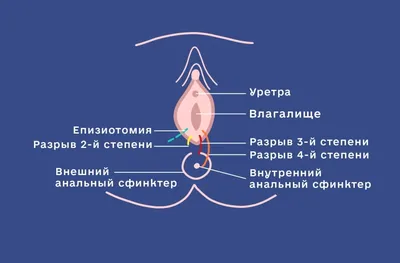 Рубцовая деформация промежности после родов