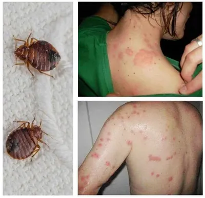 Симптомы аллергии на укусы насекомых: как распознать и правильно лечить