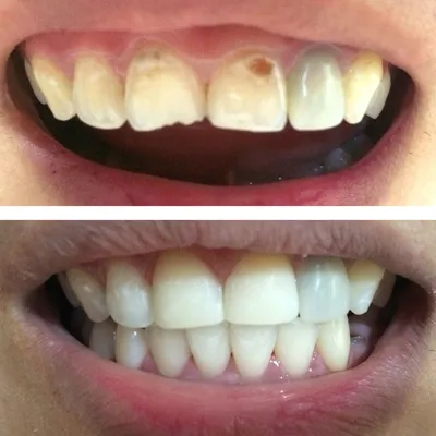 Реставрация передних зубов фото до и после фотографии