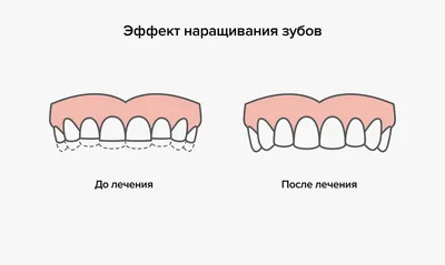 Другие примеры До и После | СТОМАТОЛОГИЧЕСКАЯ КЛИНИКА «ДЕНТ-АУРУМ» |  Чебоксары