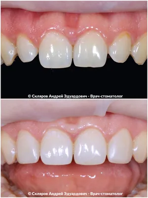 Эстетическая реставрация зубов: показания, способы, этапы | Центр  стоматологии «Ваш Стоматолог»