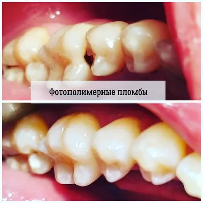 Реставрация зубов в Томске 🦷 ✓Цены ✓Фото ✓Отзывы