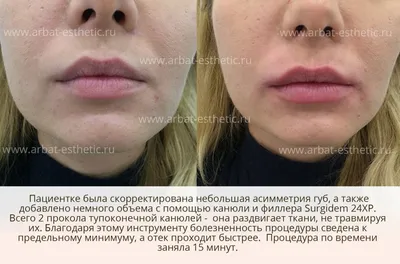 Увеличение губ филлером Рестилайн Перлайн (Restylane Perlane) - «Увеличение  губ филлером Restylane Perlane, выбор косметолога, фото до/после/в  процессе, общие рекомендации по реабилитации» | отзывы