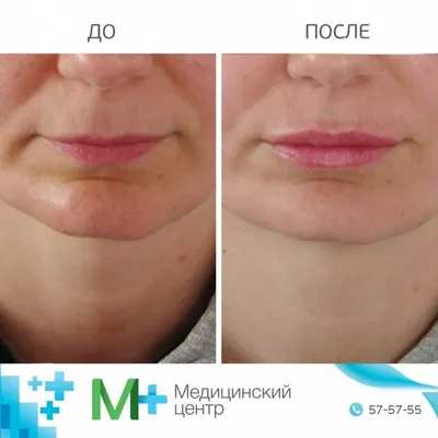Увеличение губ и коррекция формы губ в Новосибирске | Клиника косметологии  GEN87 | Цены, фото до и после, видео смотрите на сайте