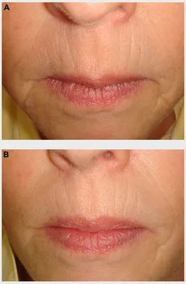 Инъекции для губ – увеличьте губы с помощью гиалуроновой кислоты