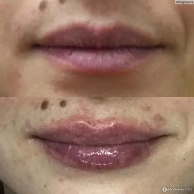 Контурная пластика губ 🤩 ⠀ Рестилайн Рефайн, 1 мл 💉(Препарат легкой  плотности ) ⠀ Тот случай, когда своя форма губ красивая… | Instagram